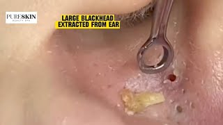 LARGE BLACKHEAD EXTRACTED FROM EAR  PURESKIN Beauty Spa Reacts Dr Dona Cravos asmr [upl. by Adok661]