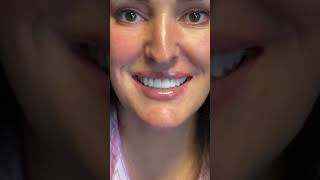 Unlocking Confidence Upper and Lower Veneer Makeover [upl. by Aradnahc]