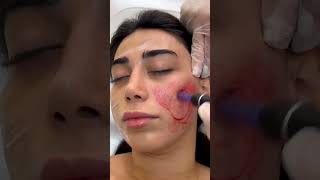 MEDİKUS KLİNİK  KOSMETOLOJİ  DERMATOLOJİ PROSEDURLAR [upl. by Vito754]