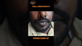 Vitiligo vitiligo lips vitiligo causes vitiligo treatment vitiligo hospital vitiligo skin [upl. by Sherourd790]