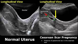 CSection Uterus Ultrasound Normal Vs Abnormal Image Appearances  Cesarean Scar Complications USG [upl. by Leanora]