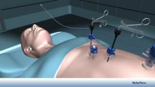 Colecistectomía Laparoscópica con el Sistema Weck® Hemolock® Auto Endo 5® [upl. by Juta]