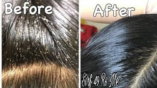 Remove 100 Lice amp Eggs Permanently with Hair Sheild Anti lice Cream 49 Rs  Farha KHan [upl. by Ettelohcin]