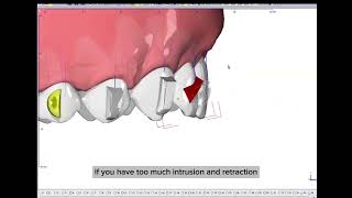 PIR protocol for CII div 2  procline intrude retract with Onyxceph [upl. by Vinnie705]