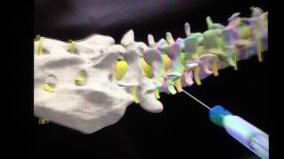 Lumbar Medial Branch Block [upl. by Inat]