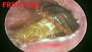 Huge Cockroach like Insect Removal from Ear [upl. by Yrhcaz746]