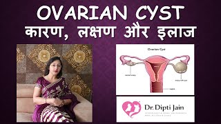 OVARIAN CYST ओवरी में गाँठ  सिस्ट HINDI Gynaecologist Dr Dipti Jain Ahmedabad [upl. by Webber607]