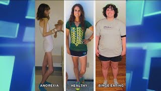 How an Anorexic Can Become a Binge Eater [upl. by Atalya]