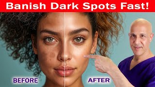 See a Change in 24 Days Banish Dark Spots Hyperpigmentation Melasma amp Acne Scars Dr Mandell [upl. by Ibloc]