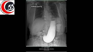 Barium Meal Follow Through Barium Procedure [upl. by Ryley]