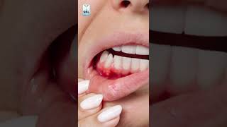 What is mouth ulcers [upl. by Lightfoot]