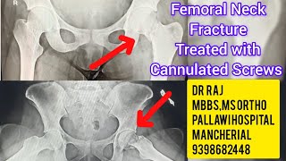 Femoral Neck Fracture Fixation with Cannulated Screwsdoctorhospitalorthopaedicsurgeonhipfracture [upl. by Melvin280]