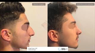 Rhinoplasty Before After for man  9 Months Result  Ozge Ergun MD Aesthetic Plastic Surgeon [upl. by Virginie]