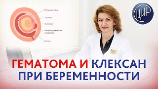 Гематома невынашивание и клексан при беременности Дементьева СН [upl. by Sweeney]