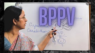 026 Benign Paroxysmal Positional Vertigo BPPV [upl. by Alaine249]