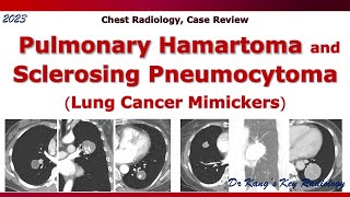 Pulmonary hamartoma amp Sclerosing pneumocytoma [upl. by Canice456]