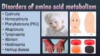 Disorders of amino acid metabolismEasy exam notes [upl. by Beckman]