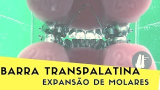 EXPANSÃO DE MOLARES POR INCLINAÇÃO [upl. by Conner]