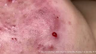 Big Cystic Acne Blackheads Extraction Blackheads amp Milia Whiteheads Removal Pimple Popping [upl. by Aihsetel]