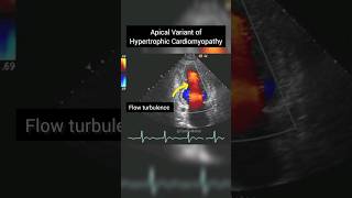 Apical Variant of Hypertrophic Cardiomyopathy on Echocardiography anatomy heart [upl. by Corabelle542]