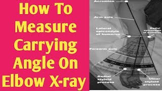 How to measure carrying angle on elbow Xray [upl. by Carolus]