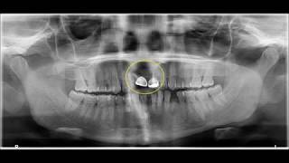 Periapical abscess incisor tooth extraction amp dental implants [upl. by Weinhardt]