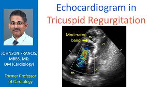 Echocardiogram in tricuspid regurgitation [upl. by Pearla]