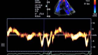 Hypertensive Heart Disease [upl. by Aneladdam]