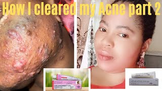 how I cleared my Acne dark spots in 7days part 2 how to use melano free creamdarkspotmelanofree [upl. by Elyrrad]