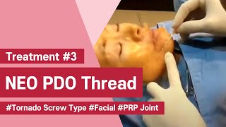 NeoGenesis Thread Series PDO Tornado Screw Type Facial Joint Procedure with PRP [upl. by Paucker159]