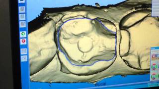 Diseño de incrustación en sistema CADCAM Cerec Godín Odontolgía Cali valle [upl. by Mad]