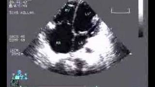 Noncoaptation of Tricuspid valve [upl. by Bright]