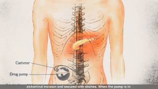 Intrathecal Pump for Pancreatic Cancer Pain Management [upl. by Neddra]