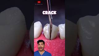 Cracked Tooth [upl. by Ative]