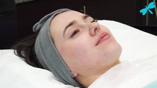 Medical Microneedling Treatment  The Laser and Skin Clinic [upl. by Namaan]