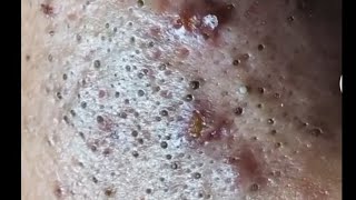 85 covered with giant blackheads skincareroutine blackheads pimples acne satisfying [upl. by Schroeder]