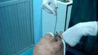 posterior nasal packing ENT PMK [upl. by Atineg]