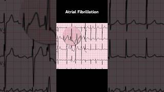 Atrial Fibrillation ECG Ashman phenomenon [upl. by Irot]