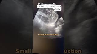 How small bowel obstruction is diagnosed on ultrasoundultrasound abdomen [upl. by Oicnanev]