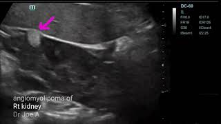 Angiomyolipoma of right kidney ultrasound video [upl. by Gnos817]