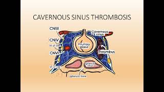 Cavernous Sinus Thrombosis PPT Slide Presentation [upl. by Aryas]