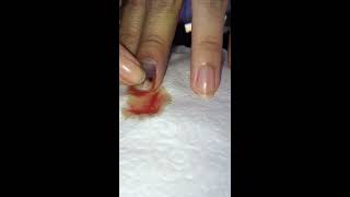 Releasing bloody fingernail blood blister pressure with Bovie cautery cauterizing fine tip [upl. by Sky]