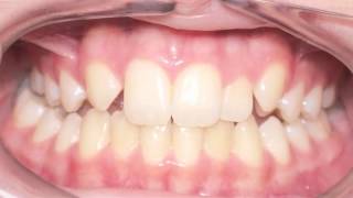 Canine Substitution Missing Lateral Incisor Kyger Orthodontics [upl. by Airt]