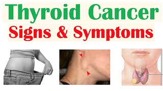 Thyroid Cancer Signs amp Symptoms amp Why They Occur [upl. by Moreville]