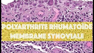 POLYARTHRITE RHUMATOÏDE  MEMBRANE SYNOVIALE  PATHOLOGIE [upl. by Earleen]