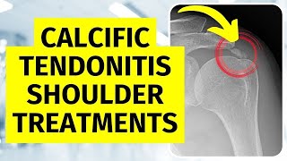 Calcific Tendonitis Shoulder Treatments Without Surgery [upl. by Besse]