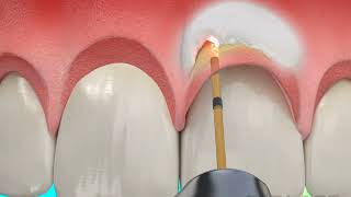 Dental Treatment  Osseous Crown Lengthening with Waterlase Laser Dentistry [upl. by Nikita]