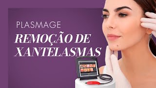 PLASMAGE  Remoção de Nevus [upl. by Arlo898]