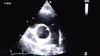 Pulmonalklappe pulmonary valve with right ventricular RV outflow view [upl. by Annaehs]