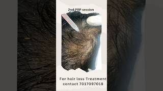 safe hair loss treatment shorts hairlosstreatment viral [upl. by Shafer]